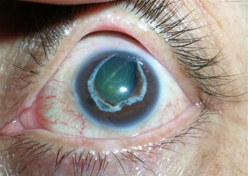 Ù On examina8on, v Persistent flat anterior chamber v Markedly raised IOP v Unresponsiveness or even aggrava6on by mio6cs v Phakic, aphakic or
