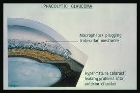 Ù Trabecular meshwork is clogged by the lens proteins, macrophages which phagocytose the