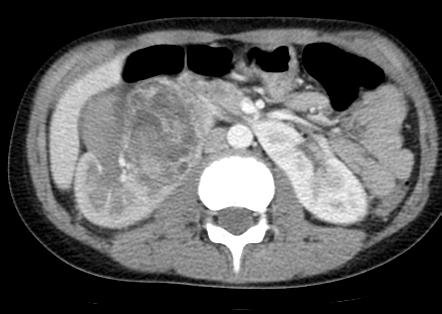 2 Case Reports in Pathology Figure 1: Abdominal computed tomography revealed an ill-defined tumor arising from the lower pole of the right kidney.