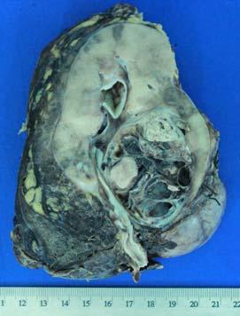 revealed a tumor surrounded by a pseudocapsule, composed of papillae covered with cells with abundant eosinophilic cytoplasm and high-grade nuclei with prominent nucleoli (Figure 3).