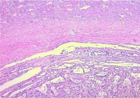 Case Reports in Pathology 3 (a) (b) (c) Figure 3: (a) Tumor pseudocapsule composed of fibrous tissue. H&E stain, 50.