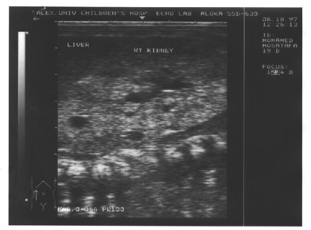 % of cases with anomalies % of total neonates Severe hydronephrosis: PUV Bilateral primary VUR Bilateral PUJO 8 5 2 1 53.33 33.33 13.33 6.67 1.6 1.0 0.4 0.2 Moderate hydronephrosis 3 20 0.