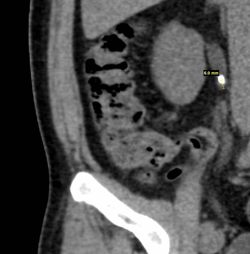 CASE 1 CT scan shows 6 mm right