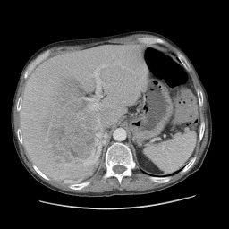 CASE # 3! 53 yr. male presents with vague abdominal pain and bloating.! Otherwise healthy, no med s.
