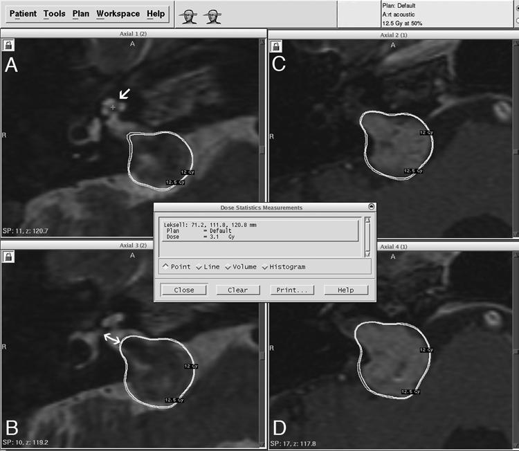 Radiosurgery for acoustic neuroma Fig. 1. A and B: Axial T2-weighted MR images obtained in a 67-year-old woman, showing a right AN (Koos Grade III at the time of SRS).