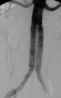 A B C Fig. 4 Patient 2. A) Abdominal angiogram after deployment of the AneuRx stent graft shows no endoleak.