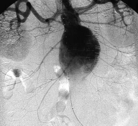 A B C D Fig. 5 Patient 4. A) Abdominal angiogram before insertion of the AneuRx stent graft reveals the presence of a large, infrarenal AAA.