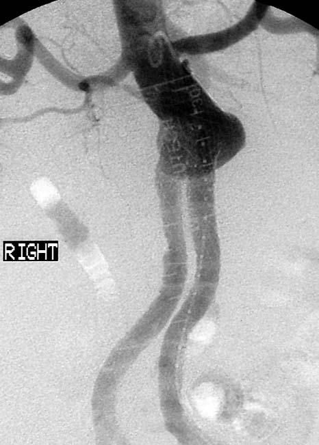 C) Abdominal angiography after 2 years shows a large endoleak in the proximal portion of the stent graft (arrows).