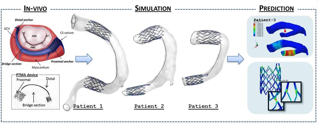 Percutaneous Mitral Annuloplasty System for the Treatment of Mitral Regurgitation ( aka.