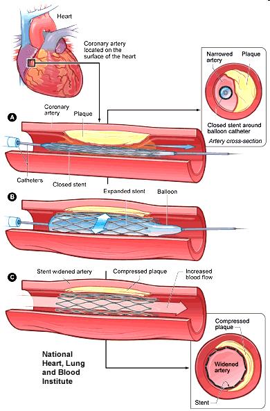 Background: CVD Treatment Three treatment options Drugs Catheter assisted procedures: Stenting Coronary artery bypass