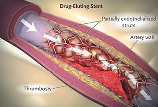 Background: Stents Today s stents have a variety of problems Stents