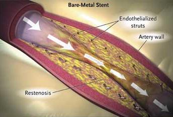 (BMS) : Restenosis smooth muscle build up Drug-eluting stents (DES) :