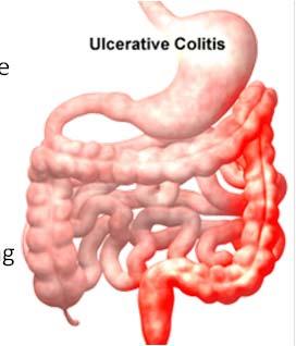Ulcerative Colitis Location: Most common on the left side of the large intestine: descending colon, sigmoid, and rectum
