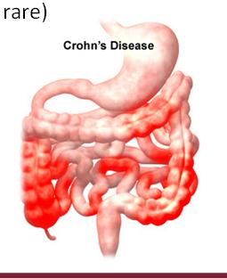 the stools Diarrhea Cyclic abdominal pain and cramping Rectal pain Weight loss, fever, fatigue Crohn s Disease Location: