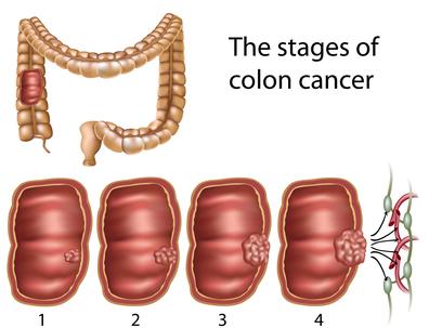 Other locations: large intestine (about 20%), small intestine alone (about 30%), stomach (rarely), mouth and esophagus (very