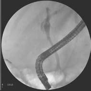 WallFlex biliary RX FULLY COVERED stent B i l i a r y D e c o m p r e s s i o n f o r Cholangiocarcinoma A 50-year-old female presented with painless jaundice and elevated Liver Function Tests.