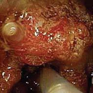 A frond-like, villous, fungating, infiltrative completely obstructing large mass was found in the recto-sigmoid colon. The mass was circumferential and measured 10cm in length.