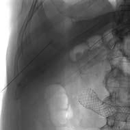WallFlex DUODENAL Stent C a s e s t u d y h e a d l i n e h e r e, c a s e R e i n t e r v e n t i o n f o r D u o d e n a l Compression A 66-year-old male had an established malignant tumor of the