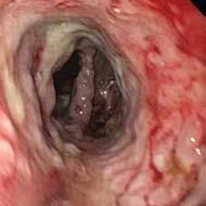 A medium-sized mass with stigmata of recent bleeding was found in the lower third of the esophagu, in the gastroesophageal junction and in the cardia.