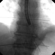 WallFlex Esophageal Fully Covered Stent C a s e s t u d y h e a d l i n e h e r e, c a s e WallFlex Esophageal Fully Covered Stent as Palliative Therapy A 67-yr-old male with malignant esophageal