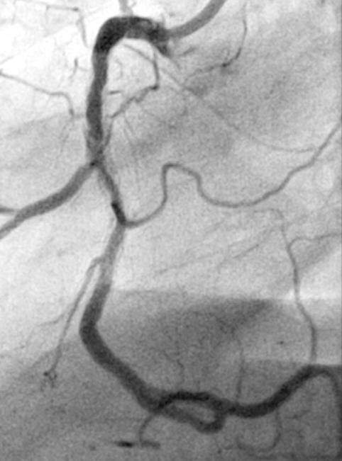 Calcified In-Stent