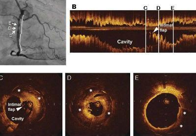 OCT-ISR Detection of atherosclerotic progression with rupture of degenerated instent intima 5