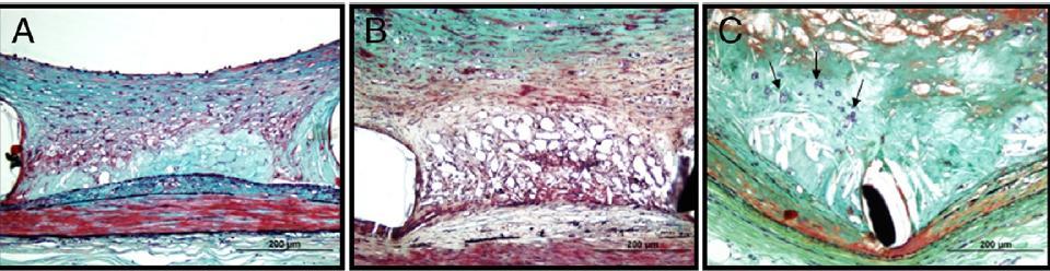 Neoatherosclerosis & ISR Newly Formed Atherosclerotic Changes Within Neointima After Stent Implantation SES implanted for 13 months Foamy macrophage clusters in the peristrut region Fibroatheroma