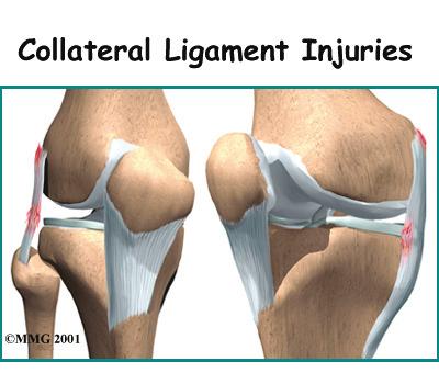 Introduction The collateral ligaments are commonly injured parts of the knee.