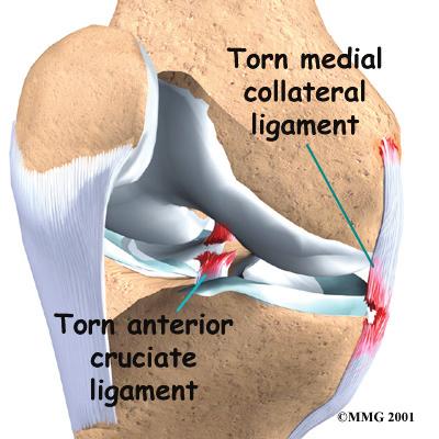 The medial collateral ligament (MCL) is found on the side of the knee closest to the other knee. The lateral collateral ligament (LCL) is found on the opposite side of the knee.