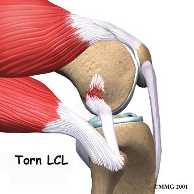 The LCL is most often injured when the knee is forced to hinge outward away from the body. It can also be torn if the knee gets snapped backward too far (hyperextended).
