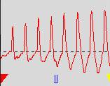 systolic pressure. As the cuff deflates further, oscillation amplitude increases to a maximum, then decreases. The point of peak oscillation amplitude is defined as the mean arterial pressure.
