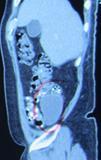 Abdominal computer tomography demonstrated a hypodense lesion, homogen density, cystic