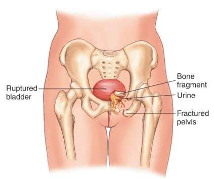 trauma on the lower abdomen, pelvis, or perineum