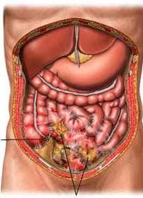 Signs of Peritonitis Abdominal pain Tenderness Muscle