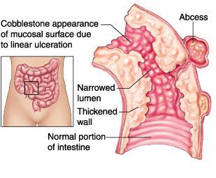Crohn s Disease Inflammatory Bowel Disease Any Part of the