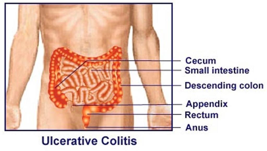 Ulcerative Colitis Inflammatory Bowel Disease