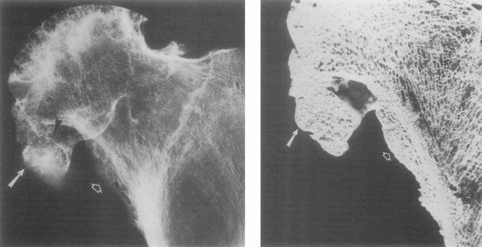 Figure 1. Marginal (epiarticular) osteophyte in osteoarthritis.
