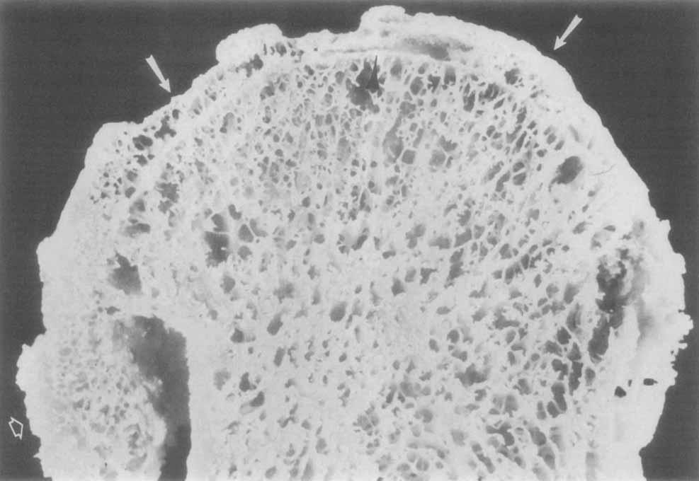 Figure 5. Central (subarticular) osteophyte in osteoarthritis.