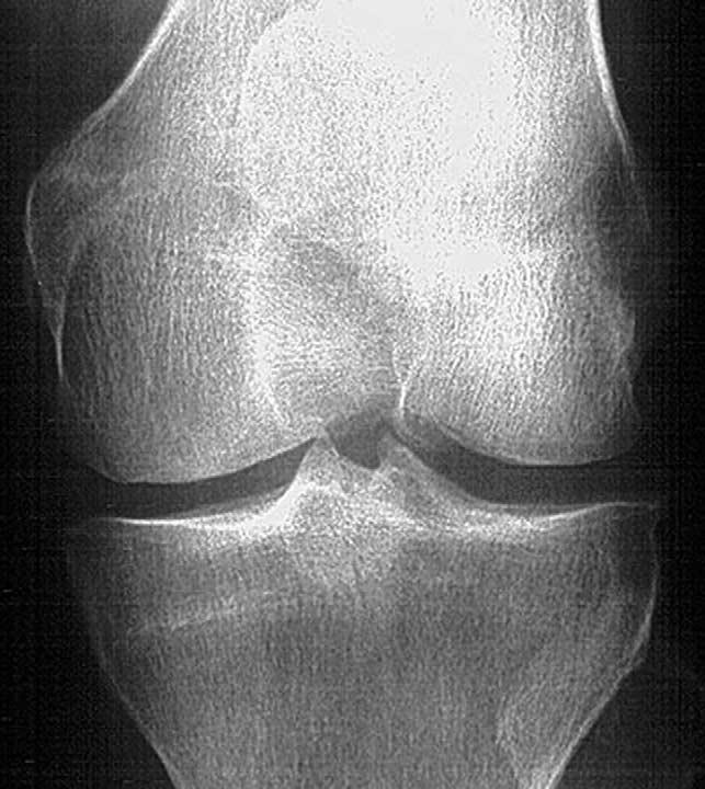 Osteoarthritis and Cartilage Vol. 11, No. 6 389 Fig. 2. The same knee joint as Fig. 1 but with local BME and cartilage defect medially, shown with MRI.