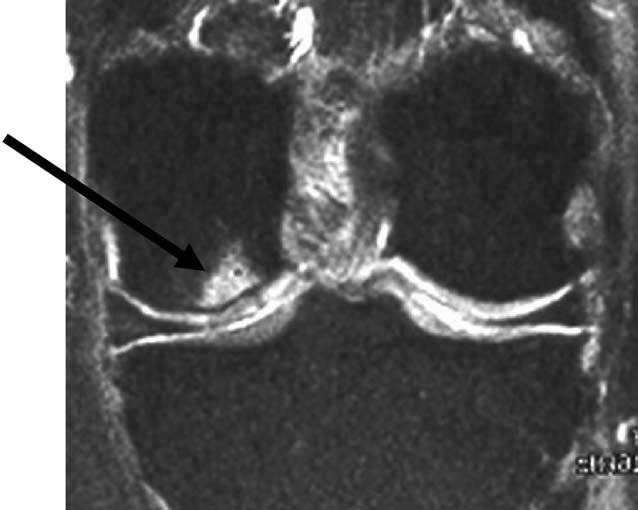 Radiographs of Arthritis 18,a standardized scoring approach that has been previously described 14.