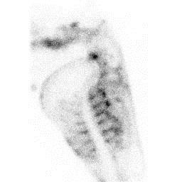 Scintigraphy 99m Technetium ( 99m Tc) Bound to phosphate (bone remodeling) Detects active