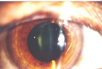 Cataract in the eye of interventional radiologist- 1990