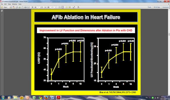 Catheter Ablation for Atrial Fibrillation in