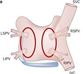 Pulmonary Vein Isolation: Cornerstone of AF Ablation Point-by-point RF lesions Encircling 2 left and 2 right PVs Irrigated RF ablation catheter Circular mapping catheter 3-dimensional mapping system
