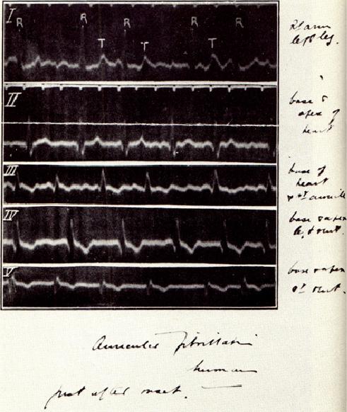 First ECG Documentation of Auricular Fibrillation Dear Professor Einthoven, By this post I am sending you some curves,