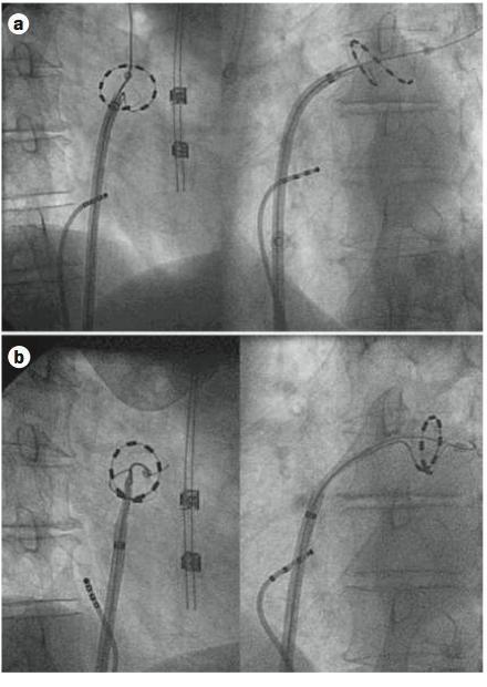 Multielectrode Ablation Catheter Ablation Frontiers