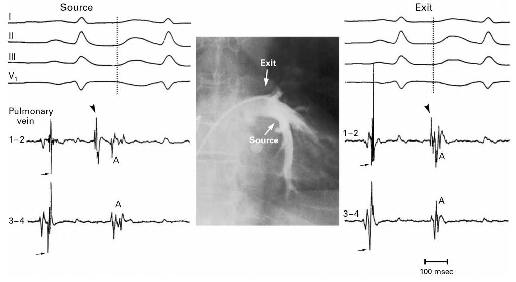 Mapping of 45 patients with paroxysmal AF AF originating in 94% in pulmonary veins Response to local radiofrequency ablation Haïssaguerre