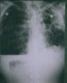 Tuberculosis (TB): Basic Facts Caused by a bacterium (Mycobacterium tuberculosis) Spread via aerosol route Most who are infected never develop active disease About 10% of infected develop active