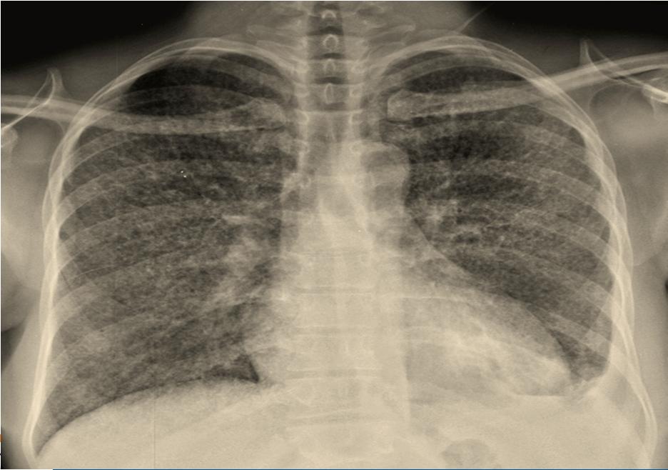Primary Tuberculosis Miliary disease: more commonly seen in the elderly, infants, and immuno-compromised host.