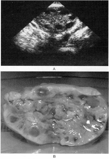 Diagnosis: PCO on ultrasound At least 1 ovary with 12+ follicles